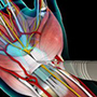 Carpal Tunnel Release Surgery 