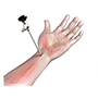 Wrist Arthroscopy 